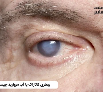 بیماری کاتاراک یا آب مروارید چیست؟
